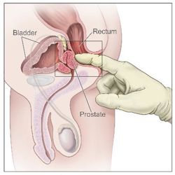 Massaging the prostate for orgasm
