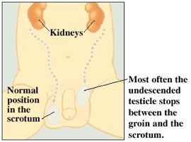 Undescended-testicle