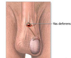 vasectomy and testosterone